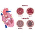 Stenosis of the aortic valve of the heart.